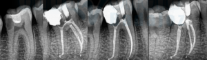 endodoncia-xray-inferiores